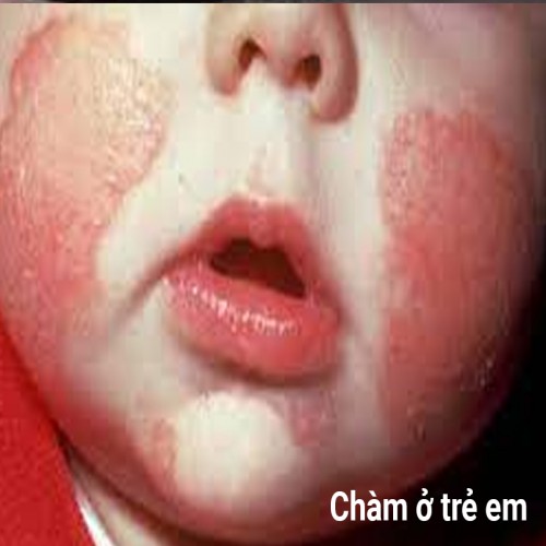 Forsancort Cream 15g